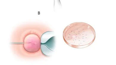 فرط التبويض يمنع الحمل