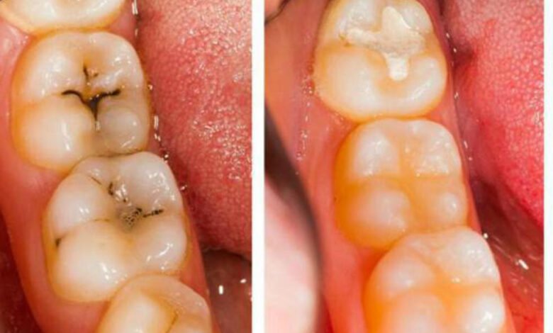 كيف أزيل تسوس الأسنان بالمنزل