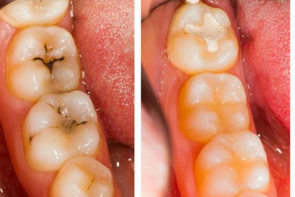 كيف أزيل تسوس الأسنان بالمنزل