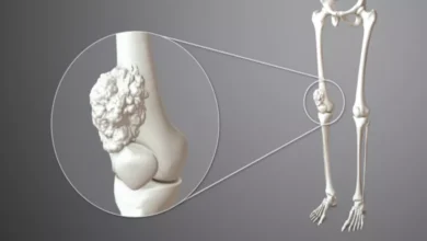 كيف يتم تشخيص سرطان العظام