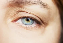 كيفية التخلص من ارتخاء جفن العين بسهولة وبمنتهى الطبيعية؟