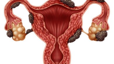 ماذا يعني مصطلح أكياس الشوكولاتة على المبيض؟
