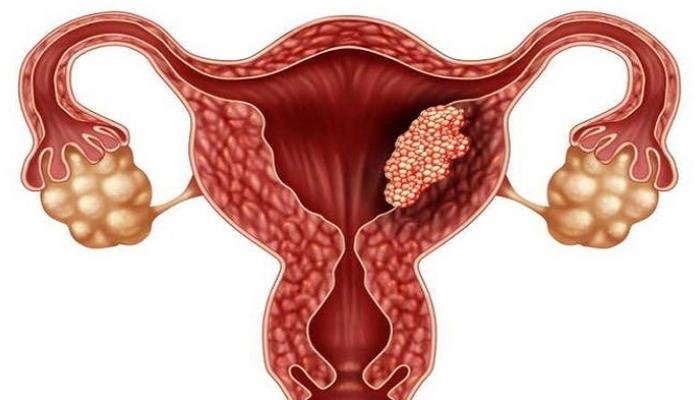 مشاكل الجهاز التناسلي عند المرأة