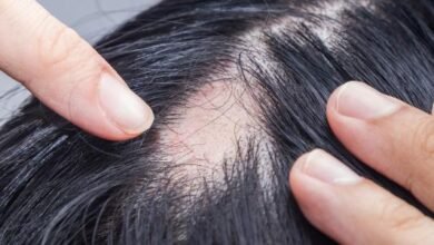 هل الثعلبة معدية