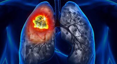 خطر سرطان الرئة على المرأة المدخنة