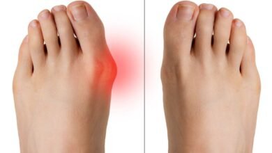 كيفية علاج الورم الملتهب لإصبع القدم بالمنزل