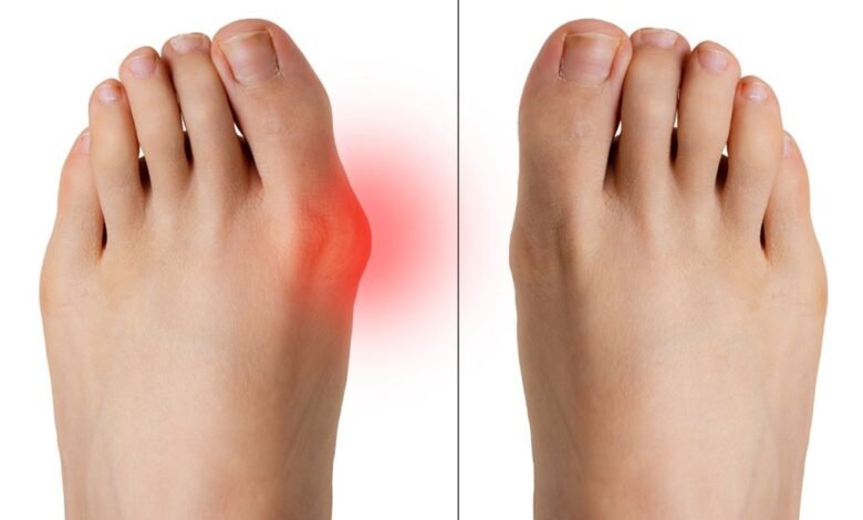 كيفية علاج الورم الملتهب لإصبع القدم بالمنزل