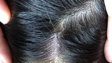 أسباب ظهور بيدرا الشعر البيضاء والسوداء