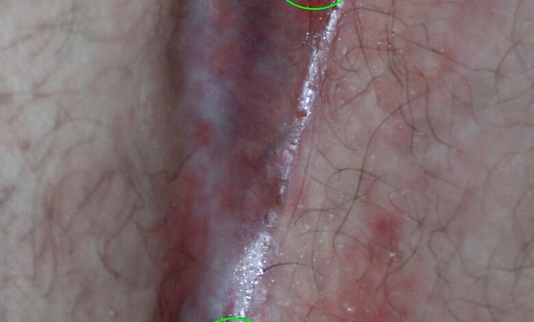 الناسور العصعصي