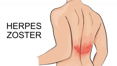 هل إصابتك بالحزام الناري تسبب الوفاة