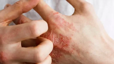 هل الحكة من علامات خروج السحر